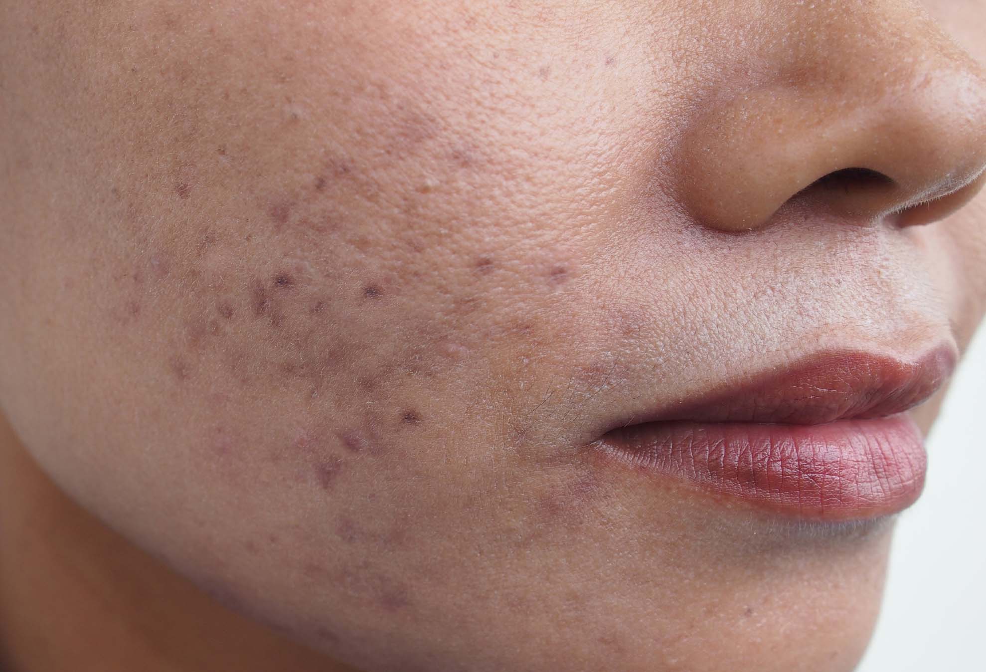 Postinflammatoire hyperpigmentatie omschrijving Laserkliniek